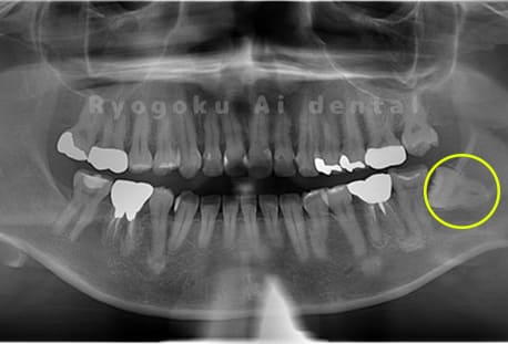下顎左1本の親知らず