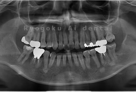 下顎左1本の親知らずを抜歯