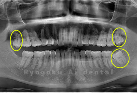 上顎左右、下顎左の親知らず