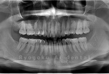 上顎左右、下顎左の親知らずを抜歯