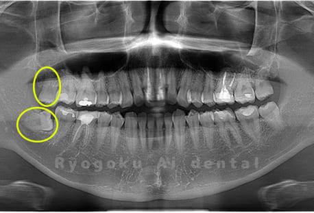 上顎右、下顎右の親知らず