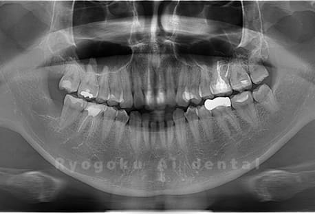 上顎右、下顎右の親知らずを抜歯