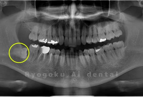 下顎右の親知らず
