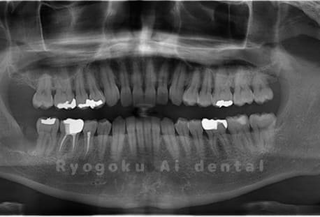 下顎右の親知らずを抜歯