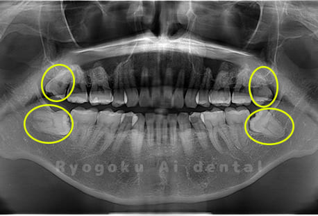 上下顎左右の4本の親知らず