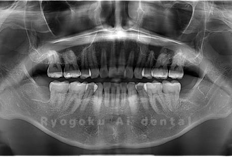 上下顎左右の4本の親知らずを抜歯