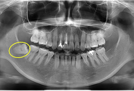 下顎右の1本の親知らず