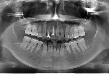 下顎右の1本の親知らずを抜歯