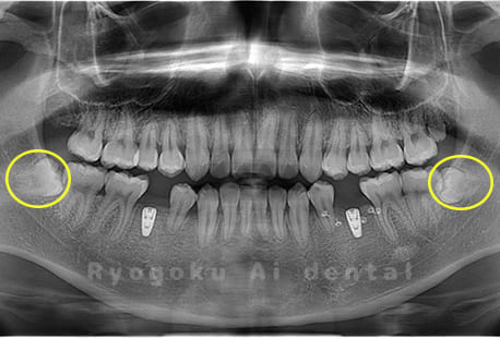 下顎左右の埋伏の親知らず