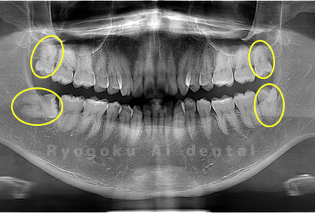 上下顎左右の埋伏の親知らず
