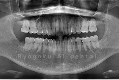 上下顎左右の埋伏の親知らずを抜歯
