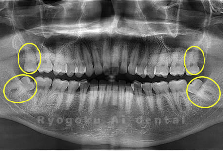 上下顎左右の埋伏の親知らず