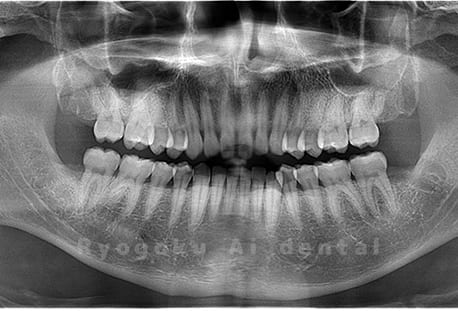 上下顎左右の埋伏の親知らずを抜歯
