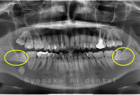 下顎左右の埋伏の親知らず