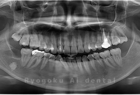 下顎左右の埋伏の親知らずを抜歯