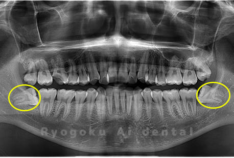 上下顎左右の埋伏の親知らず