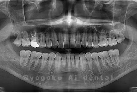 上下顎左右の埋伏の親知らずを抜歯