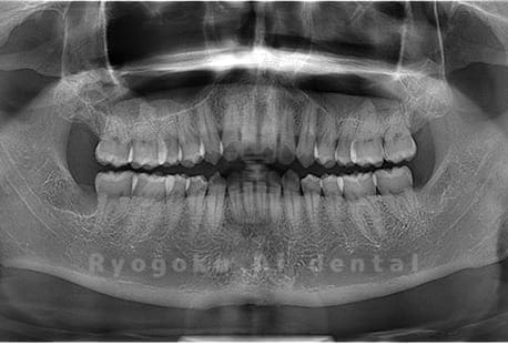 上下顎左右の親知らずを抜歯