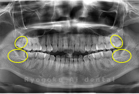 上下顎左右の親知らず