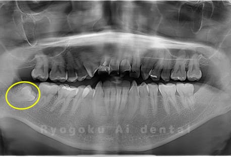 下顎右の埋伏の親知らず