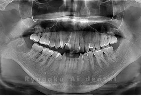 下顎右の埋伏の親知らず1本を抜歯