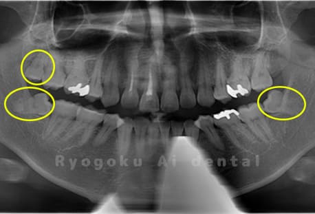 上顎右、下顎左右の親知らず