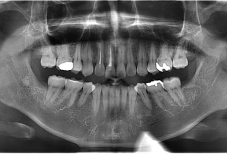 上顎右、下顎左右の3本の親知らずの抜歯