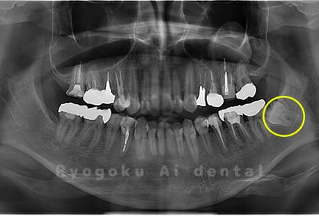 下顎左の埋伏の親知らず