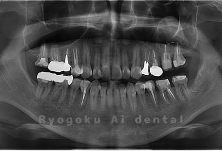下顎左の埋伏の親知らずの抜歯
