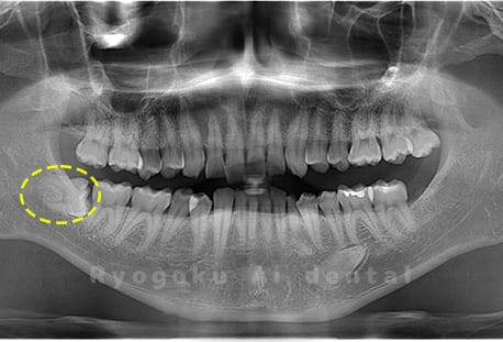 下顎右の埋伏の親知らず