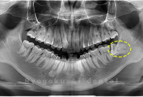 下顎左の埋伏の親知らず