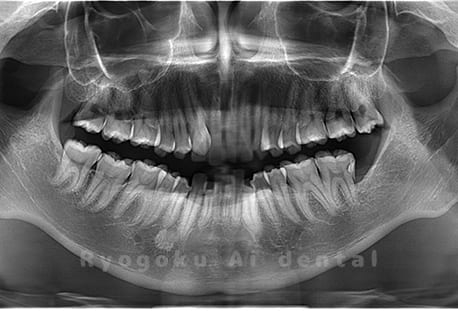 下顎左の埋伏の親知らずの抜歯
