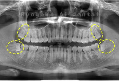 上下顎左右の親知らず