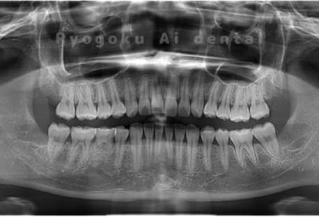上下顎左右の親知らずの抜歯