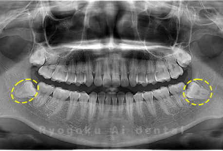 下顎左右の親知らず