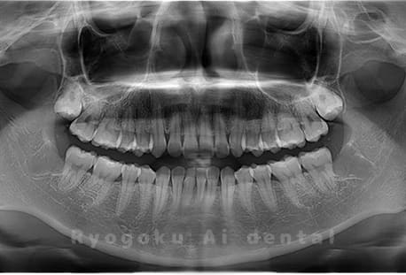 下顎左右の親知らずの抜歯
