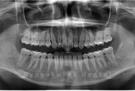 下顎左右の親知らずの抜歯