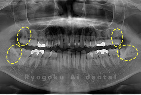 上顎下顎左右の親知らず