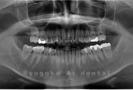 上顎下顎左右の親知らずの抜歯