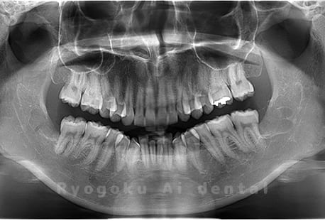 下顎左右の親知らずの抜歯