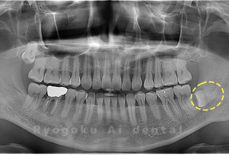 下顎左の親知らず