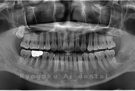 下顎左の親知らずの抜歯