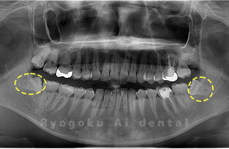 下顎左右の親知らず