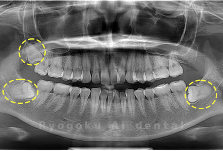上顎左埋伏親知らず、下顎左右の親知らず
