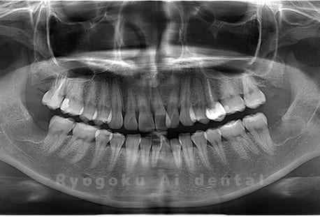 上顎左埋伏親知らず、下顎左右の親知らず