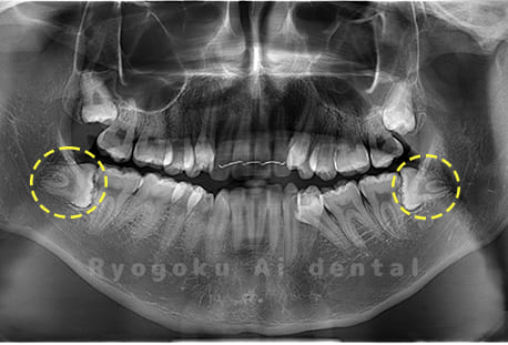 下顎左右の親知らず