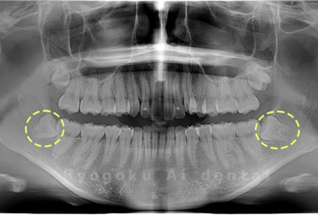 下顎左右の親知らず