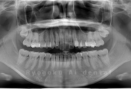 下顎左右の親知らずの抜歯