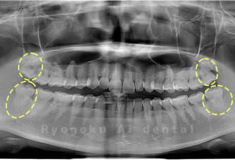 上下顎左右の親知らず