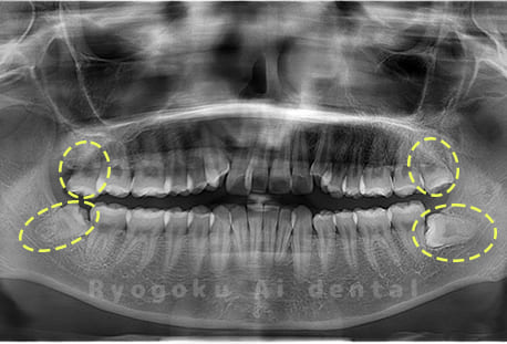 上下顎左右の親知らず